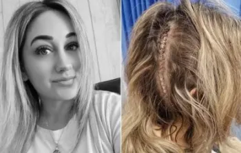 Mulher suspeita de sequela de acidente e descobre c�ncer