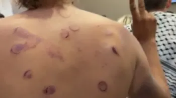 Ativistas da flotilha com hematomas e fraturas