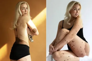 A estudante Scarlett Clarke, que tem manchas no corpo, foi diagnosticada com uma condi��o rara. Foto: Reprodu��o/Instagram