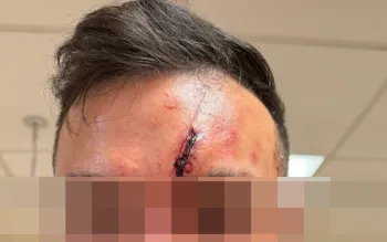 'James' sofreu m�ltiplas les�es graves na cabe�a, m�os e costelas