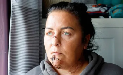 Ataques de c�es deixam m�e com o rosto destru�do e adolescente com l�bio pendurado na Esc�cia