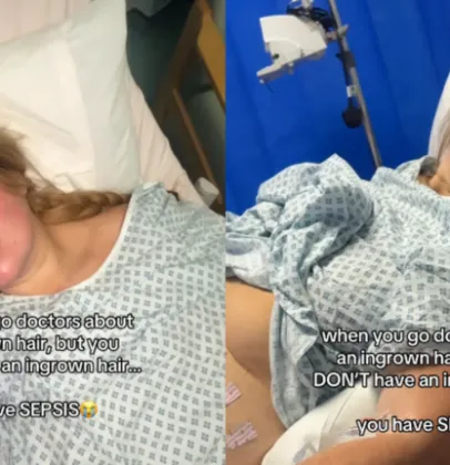 Pelo encravado causa infec��o grave e quase leva influenciadora brit�nica � morte