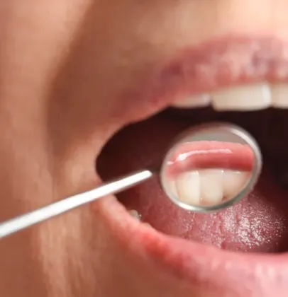 Por que seu t�rtaro volta t�o r�pido? Dentista revela o segredo da sua saliva