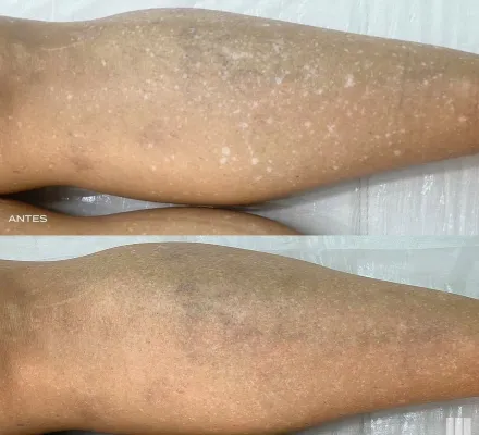 De olho no ver�o: a t�cnica que promete apagar aquelas manchinhas brancas na pele