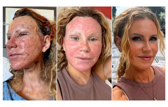 Mulher mostra como � a recupera��o de uma cirurgia pl�stica sem esconder nada